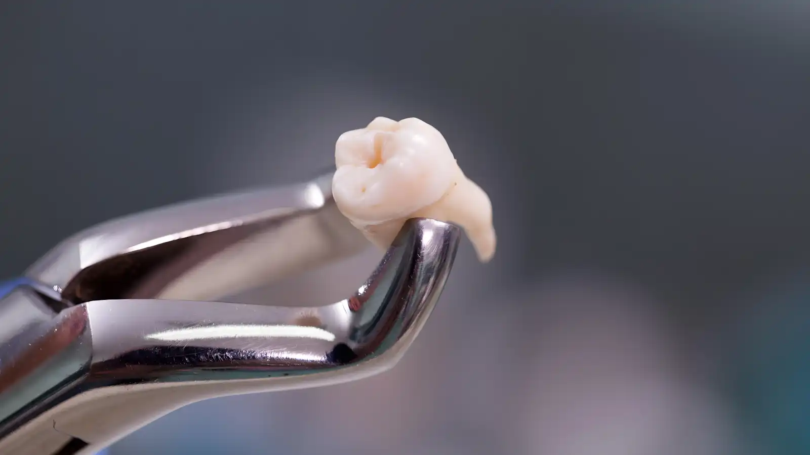 Dentes Sisos: O Que São, Quando Retirar e Cuidados Essenciais
